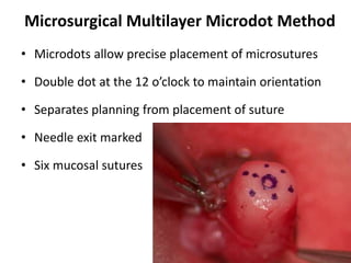 Microsurgical Multilayer Microdot Method
• Microdots allow precise placement of microsutures
• Double dot at the 12 o’clock to maintain orientation
• Separates planning from placement of suture
• Needle exit marked
• Six mucosal sutures
 