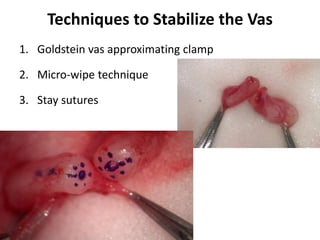 Techniques to Stabilize the Vas
1. Goldstein vas approximating clamp
2. Micro-wipe technique
3. Stay sutures
 