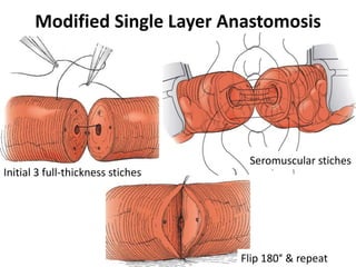 Modified Single Layer Anastomosis
Flip 180° & repeat
Seromuscular stiches
Initial 3 full-thickness stiches
 