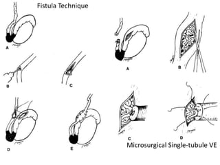 Microsurgical Single-tubule VE
Fistula Technique
 