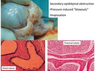 Secondary epididymal obstruction
•Pressure-induced “blowouts”
•Inspissation
Distal tubule
Proximal tubule
 