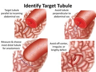 Identify Target Tubule
Target tubule
parallel to incoming
abdominal vas
Avoid tubule
perpendicular to
abdominal vas
Avoid off-center,
irregular, or
lengthy defect
Measure & choose
most distal tubule
for anastomosis
 