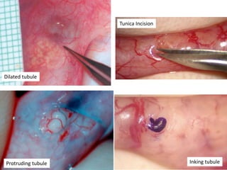 Protruding tubule Inking tubule
Tunica Incision
Dilated tubule
 