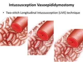 Intussusception Vasoepididymostomy
• Two-stitch Longitudinal Intussusception (LIVE) technique
 