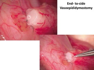 End- to-side
Vasoepididymostomy
 