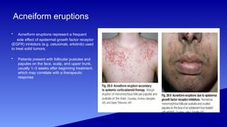 azrin Acne vulgaris and Rosacea (1) (1).pptx