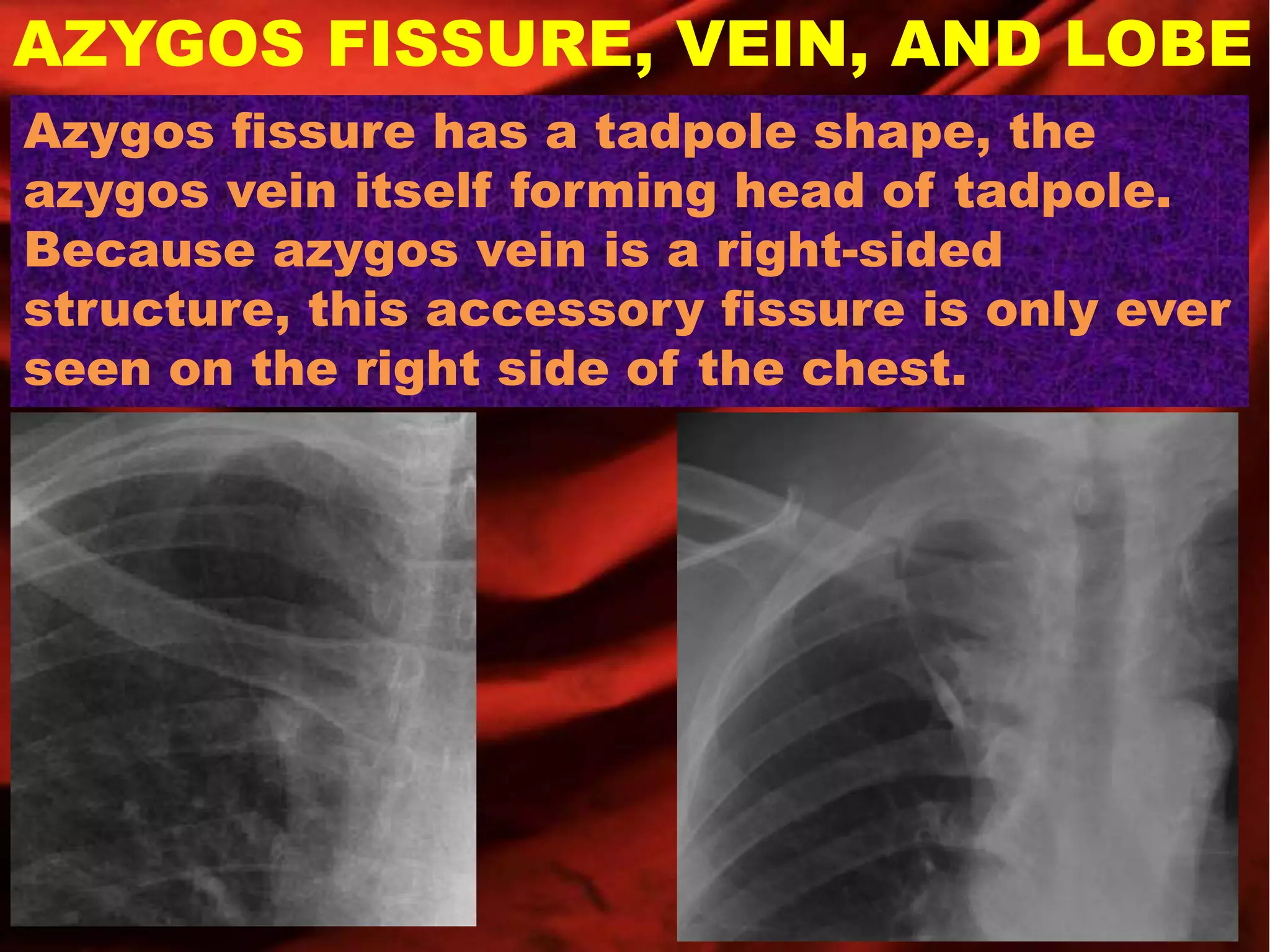 Azygos fissure, vein, and lobe PPT