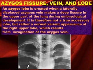 AZYGOS FISSURE, VEIN, AND LOBE
An azygos lobe is created when a laterally
displaced azygous vein makes a deep fissure in
the upper part of the lung during embryological
development. It is therefore not a true accessory
lobe, but rather a normal variant appearance of
the right upper lobe, which results
from invagination of the azygos vein.
 