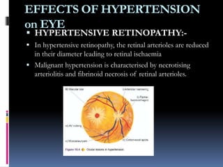 EFFECTS OF HYPERTENSION
on EYE
 HYPERTENSIVE RETINOPATHY:-
 In hypertensive retinopathy, the retinal arterioles are reduced
in their diameter leading to retinal ischaemia
 Malignant hypertension is characterised by necrotising
arteriolitis and fibrinoid necrosis of retinal arterioles.
 