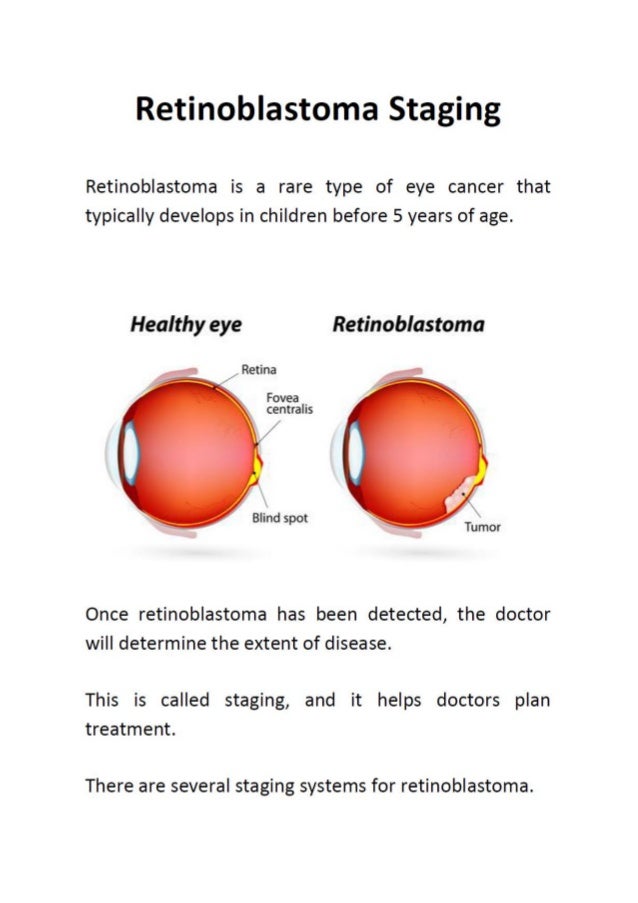 Retinoblastoma Staging