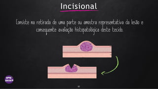 Incisional
10
 