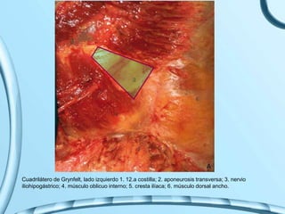 Cuadrilátero de Grynfelt, lado izquierdo 1. 12.a costilla; 2. aponeurosis transversa; 3. nervio
iliohipogástrico; 4. músculo oblicuo interno; 5. cresta ilíaca; 6. músculo dorsal ancho.
 