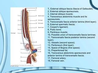 1, External oblique fascia (fascia of Gallaudet);
2, External oblique aponeurosis;
3, Internal oblique muscle;
4, Transversus abdominis muscle and its
aponeurosis;
5, Transversalis fascia anterior lamina (third layer);
6, External spermatic fascia;
7, Cooper's ligament;
8, Pubic bone;
9, Pectineus muscle;
10, Possible union of transversalis fascia laminae;
11, Transversalis fascia posterior lamina (second
layer);
12, Vessels (second space);
13, Peritoneum (first layer);
14, Space of Bogros (first space);
15, Preperitoneal fat;
16, Transversus abdominis aponeurosis and
anterior lamina of transversalis fascia;
17, Femoral artery;
18, Femoral vein.
 