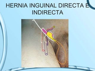 HERNIA INGUINAL DIRECTA E
INDIRECTA
 