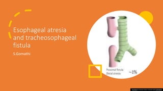 Esophageal atresia
and tracheosophageal
fistula
S.Gomathi
This Photo by Unknown Author is licensed under CC BY-SA-NC
 