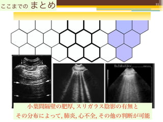 ここまでの   まとめ                      11




    小葉間隔壁の肥厚, スリガラス陰影の有無と
  その分布によって, 肺炎, 心不全, その他の判断が可能
 