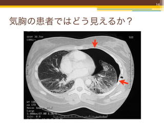 14




気胸の患者ではどう見えるか？
 
