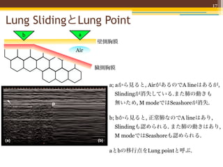 17


  Lung SlidingとLung Point
              b                                     a
                                                                 壁側胸膜
                                                  Air
               Available online http://ccforum.com/content/11/1/205

                                                               臓側胸膜
Figure 7

                                                                         a; aから見ると, AirがあるのでA lineはあるが,
                                                                          Slindingが消失している.また肺の動きも
                                                                          無いため, M modeではSeashoreが消失.

                                                                         b; bから見ると, 正常肺なのでA lineはあり,
                                                                          Slindingも認められる. また肺の動きはあり,
                                                                          M modeではSeashoreも認められる.

                                                                         aとbの移行点をLung pointと呼ぶ.
Time-motion mode lung ultrasound. (a) Normal lung and (b)
pneumothorax patterns using time-motion mode lung ultrasound. In
time motion mode, one must first locate the pleural line (white arrow)
 