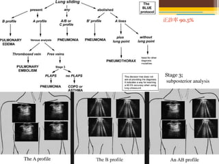 正診率 90.5%




Stage 3;
subposterior analysis
 