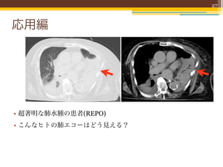 27



応用編




• 超著明な肺水腫の患者(REPO)
• こんなヒトの肺エコーはどう見える？
 