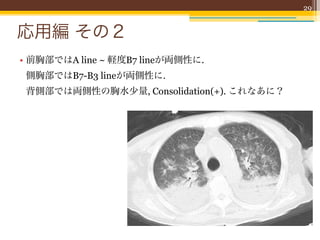 29


応用編 その２
• 前胸部ではA line ~ 軽度B7 lineが両側性に.
 側胸部ではB7-B3 lineが両側性に.
 背側部では両側性の胸水少量, Consolidation(+). これなあに？
 