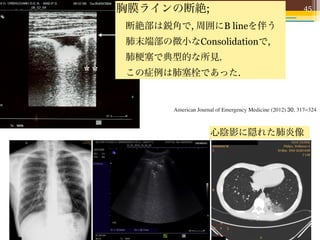 some B-lines in the surrounding area (asterisks). This image is
                                                           intercostal scan (focal interstitial syndrome), periphe
                                                       胸膜ラインの断絶; attending EP. Particular irregularity of t
                                                                  Physical examination and history were recorded 45
    typical of a small lung consolidation due to a peripheral infarction.
    Final diagnosis was pulmonary embolism.                alveolar consolidation, or disruption with attention was
                                                               presentation by the
                                                                                                                     at

                                                           pleural line to specific symptoms, such as history and 2).
                                                               reserved with or without effusion (Figs. 1 of cough,
                                                    断絶部は鋭角で, 周囲にB lineを伴う
    patient localized the pain. Maximal inspiration and exhala-         hemoptysis, and fever along with pleuritic pain.
    tion were used to gain access to areas covered by solid 2.3. Blood sample
                                                    肺末端部の微小なConsolidationで,
    structures of the thoracic cage. Breath holding by the patient      2.5. Diagnostic criteria
    was useful to exclude breath motion–related artifacts.
    Further details on the technique and pathologic signs塞で典型的な所見.blood determined from at admission a
                                                    肺 of A sample of whole were was collected independent
                                                                           All final diagnoses
    LUS are described in a previously published article [3].        sentreviewers laboratory. D-dimer the following procedures:
                                                                          to the after a combination of plasma level was assess
                                                    この症例は肺塞栓であった.
        An examination of the painful thoracic area was by spiral computer tomography (sCT), perfusional scintigraphy,
                                                                         latex-enhanced turbidimetric quantitative test (Dad
                                                                        positron emission tomography (PET), compression ultraso-
    considered normal in presence of both the respiratory pleural Behring, Milan, Italy; normal value [NV] b283 ng/mL
    sliding and the scattered aerated image under the pleural line,     nography of the legs, follow-up at few days and 1 to 3 months,
    without visualization of multiple vertical linear echogenic C-reactive protein (CRP) The risk profile for pulmonary
                                                                        and response to treatment. plasma level was assessed
    artifacts named B lines (B+ pattern) [3,5,6]. Lung ultrasound immunoturbidimetric method (SentinelWells criteria [7].
                                                                        thromboembolism was recorded after the Diagnostics, Milan
    was considered positive when direct scanning of the painful Italy; NV patientsmg/dL). White blood cell (WBC)317–324w
                                                                           All b0.71 diagnosed with Medicine (2012) 30, count
                                                                           American Journal of Emergency parietal chest pain of an
    chest area allowed visualization of at least one of the determined as part of the Multi-Angle-Polarised-Scatte
                                                                        unknown origin were discharged without therapy and
    following: absence of sliding, B+ pattern on more than 1 Separation (Abbott, IL; NV 4.5-11.6 × 109/L). blood
                                                                        submitted to a 2-step clinical examination and
                                                                                              心陰影に隠れた肺炎像
sruption of the pleural line (white arrow) with a wedge-
ural-based hypoechoic image with sharp margins and                          2.4. Symptoms
es in the surrounding area (asterisks). This image is
small lung consolidation due to a peripheral infarction.                       Physical examination and history were recorded
osis was pulmonary embolism.                                                presentation by the attending EP. Particular attention w
                                                                            reserved to specific symptoms, such as history of coug
alized the pain. Maximal inspiration and exhala-                            hemoptysis, and fever along with pleuritic pain.
 used to gain access to areas covered by solid
of the thoracic cage. Breath holding by the patient                         2.5. Diagnostic criteria
 l to exclude breath motion–related artifacts.
tails on the technique and pathologic signs of                                 All final diagnoses were determined from independe
escribed in a previously published article [3].                             reviewers after a combination of the following procedure
 