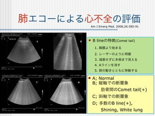 肺エコーによる心不全の評価
           Am J Emerg Med. 2008;26:585-91




           B lineの特徴(Comet tail)
             1. 胸膜より始まる
             2. レーザーのように明確
             3. 減衰せずに末梢まで見える
             4. Aラインを消す
             5. 肺の動きとともに移動する

          A; Normal
           B; 縦軸での断層象
             肋骨間のComet tail(+)
           C; 斜軸での断層象
           D; 多数のB line(+),
             Shining, White lung
 