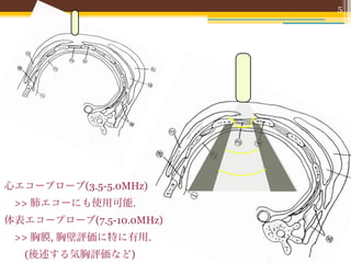 5




心エコープローブ(3.5-5.0MHz)
 >> 肺エコーにも使用可能.
体表エコープローブ(7.5-10.0MHz)
 >> 胸膜, 胸壁評価に特に有用.
  (後述する気胸評価など)
 