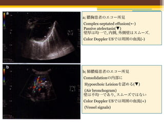 a; 膿胸患者のエコー所見
Complex-septated effusion(←)
Passive atelectasis(▼)
壁厚は均一で, 内側, 外側壁はスムーズ.
Color Doppler USでは周囲の血流(-)




b; 肺膿瘍患者のエコー所見
Consolidationの内部に
Hypoechoic Leisionを認める(▼)
(Air bronchogram)
壁は不均一であり, スムーズではない
Color Doppler USでは周囲の血流(+)
(Vessel signals)
 
