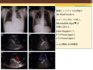 胸部レントゲンでは同様の
Air-Fluid Level(+).
 



エコーでも不均一の壁と,
Microbubble Sign(▼)を
同様に認める.
Color Dopplerにて,
fではVessel sign(+)
cではVessel sign(-)

⇒ aは膿胸, dは肺膿瘍
 