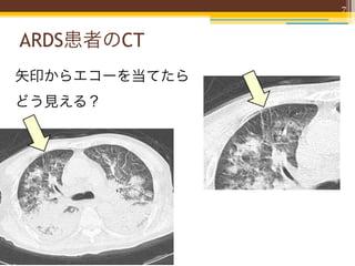 7



ARDS患者のCT
矢印からエコーを当てたら
どう見える？
 