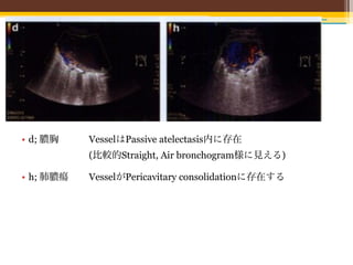 • d; 膿胸    VesselはPassive atelectasis内に存在
           (比較的Straight, Air bronchogram様に見える)

• h; 肺膿瘍   VesselがPericavitary consolidationに存在する
 