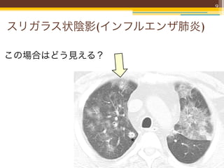 9



スリガラス状陰影(インフルエンザ肺炎)

この場合はどう見える？
 