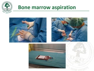 Bone marrow aspiration
 