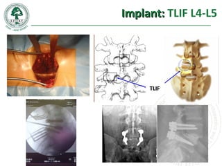 Implant:Implant: TLIF L4-L5
TLIFTLIF
 