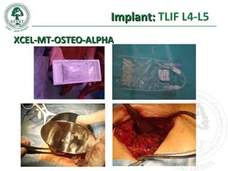 Implant:Implant: TLIF L4-L5
XCEL-MT-OSTEO-ALPHAXCEL-MT-OSTEO-ALPHA
 