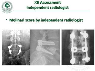 XR AssessmentXR Assessment
independent radiologistindependent radiologist
• Molinari score by independent radiologistMolinari score by independent radiologist
 