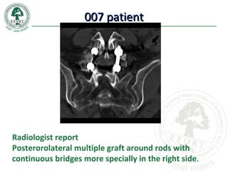 007 patient007 patient
Radiologist report
Posterorolateral multiple graft around rods with
continuous bridges more specially in the right side.
 
