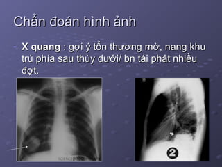 Chẩn đoán hình ảnhChẩn đoán hình ảnh
- X quangX quang : gợi ý tổn thương mờ, nang khu: gợi ý tổn thương mờ, nang khu
trú phía sau thùy dưới/ bn tái phát nhiềutrú phía sau thùy dưới/ bn tái phát nhiều
đợt.đợt.
 