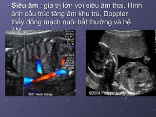 -- Siêu âmSiêu âm : giá trị lớn với siêu âm thai. Hình: giá trị lớn với siêu âm thai. Hình
ảnh cấu trúc tăng âm khu trú, Dopplerảnh cấu trúc tăng âm khu trú, Doppler
thấy động mạch nuôi bất thường và hệthấy động mạch nuôi bất thường và hệ
TM.TM.
 