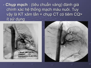 -- Chụp mạchChụp mạch : (tiêu chuẩn vàng) đánh giá: (tiêu chuẩn vàng) đánh giá
chính xác hệ thống mạch máu nuôi. Tuychính xác hệ thống mạch máu nuôi. Tuy
vậy là KT xâm lấn + chụp CT có tiêm CQ>vậy là KT xâm lấn + chụp CT có tiêm CQ>
ít sử dụngít sử dụng
 
