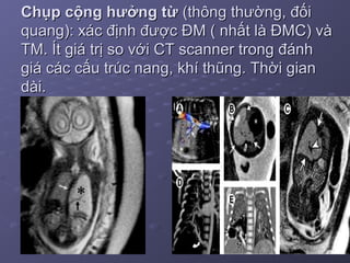 Chụp cộng hưởng từChụp cộng hưởng từ (thông thường, đối(thông thường, đối
quang): xác định được ĐM ( nhất là ĐMC) vàquang): xác định được ĐM ( nhất là ĐMC) và
TM. Ít giá trị so với CT scanner trong đánhTM. Ít giá trị so với CT scanner trong đánh
giá các cấu trúc nang, khí thũng. Thời giangiá các cấu trúc nang, khí thũng. Thời gian
dài.dài.
 