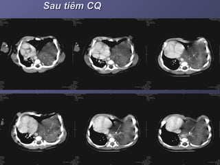 Sau tiêm CQSau tiêm CQ
 