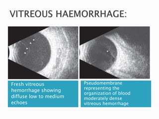 Fresh vitreous
hemorrhage showing
diffuse low to medium
echoes
Pseudomembrane
representing the
organization of blood
moderately dense
vitreous hemorrhage
 