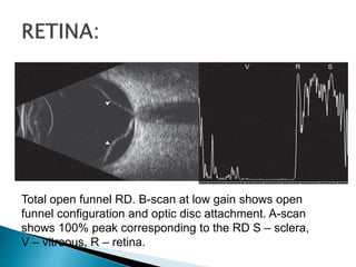 Total open funnel RD. B-scan at low gain shows open
funnel configuration and optic disc attachment. A-scan
shows 100% peak corresponding to the RD S – sclera,
V – vitreous, R – retina.
 