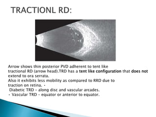 Arrow shows thin posterior PVD adherent to tent like
tractional RD (arrow head).TRD has a tent like configuration that does not
extend to ora serrata.
Also it exhibits less mobility as compared to RRD due to
traction on retina. •
Diabetic TRD – along disc and vascular arcades.
• Vascular TRD – equator or anterior to equator.
 