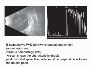 B-scan shows PVD (arrow), choroidal detachment
(arrowhead), and
vitreous hemorrhage (VH).
A-scan shows the characteristic double
peak on initial spike The probe must be perpendicular to see
the double peak.
 