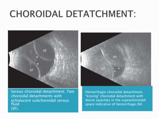 Serous choroidal detachment. Two
choroidal detachments with
echolucent subchoroidal serous
fluid
(SF).
Hemorrhagic choroidal detachment.
“kissing” choroidal detachment with
dense opacities in the suprachoroidal
space indicative of hemorrhage (SH
 
