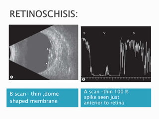 B scan- thin ,dome
shaped membrane
A scan –thin 100 %
spike seen just
anterior to retina
 