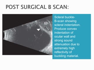 Scleral buckle-
B-scan showing
scleral indentation.
Produce convex
indentation of
ocular wall and
strong sound
attenuation due to
extremely high
reflectivity of
buckling material.
 